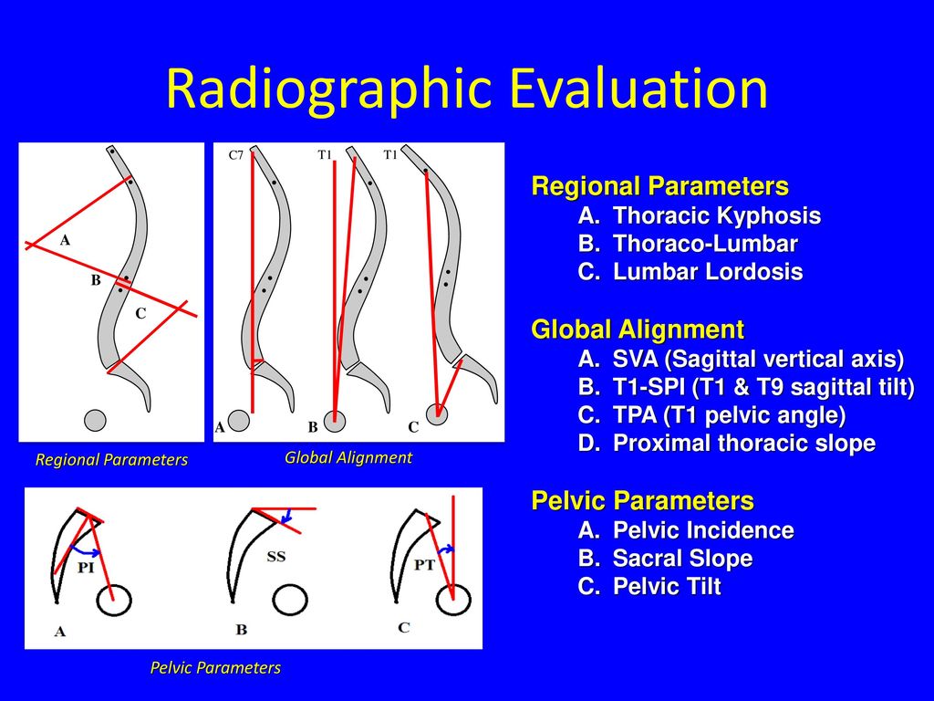 State of the Art in Sagittal Balance - ppt video online ...