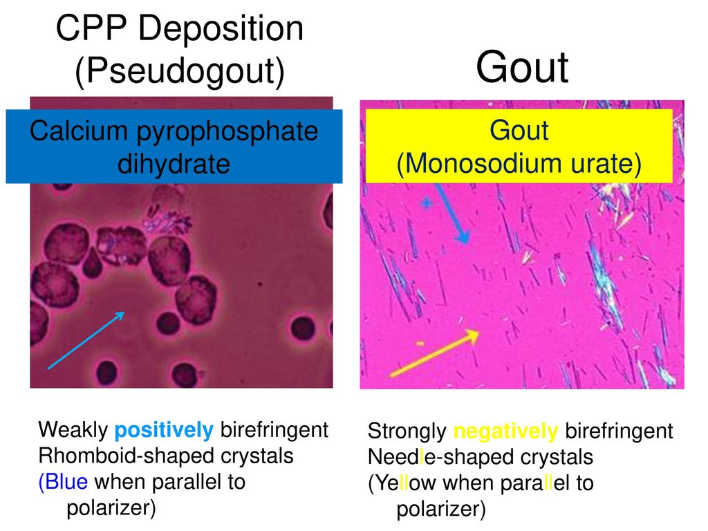 gout vs pseudogout crystals