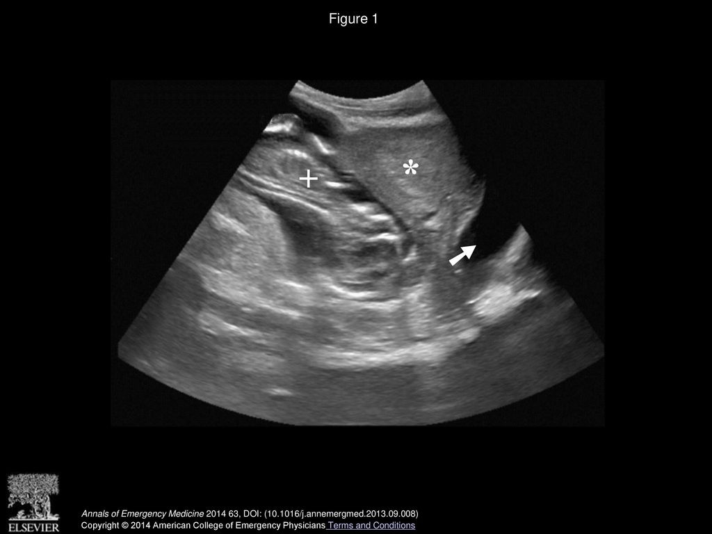 Figure 1 Transabdominal ultrasonography with visualization of the uterus (*), bladder (arrow), and fetal heart (+).