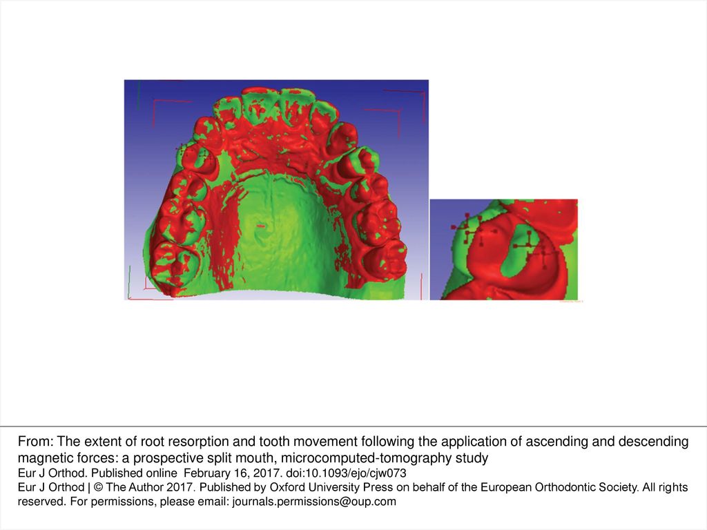 Figure 5. 3D superimposition on palatal rugae to measure tooth movement. Initial, in red; after treatment, in green.