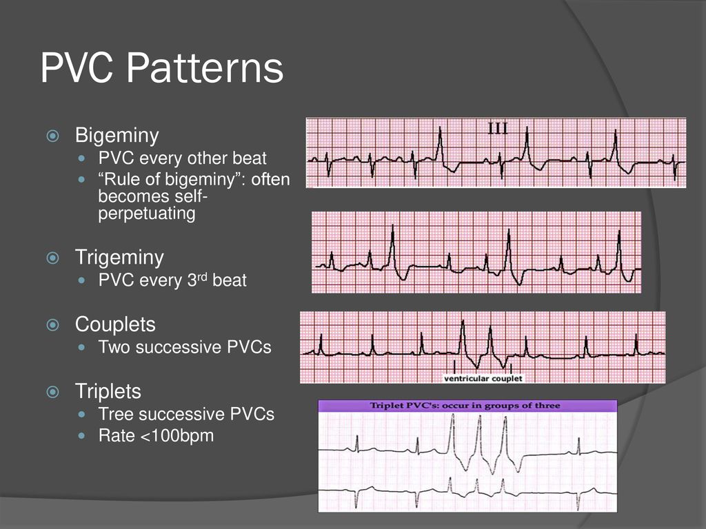 Ventricular Arrhythmias Ppt Download Ventricular Arrhythmias Ppt Download