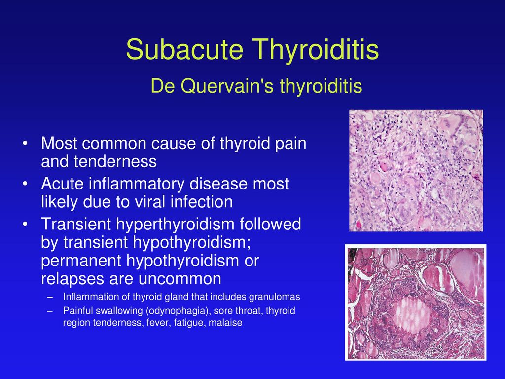Subacut granulamatosus (De Quervain’s) thyreoiditis