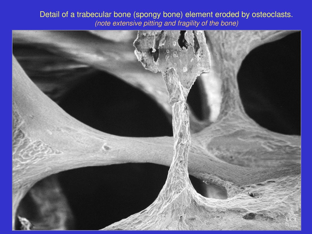 (note extensive pitting and fragility of the bone)