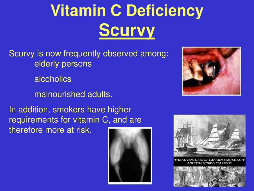 Vitamin C Deficiency Scurvy