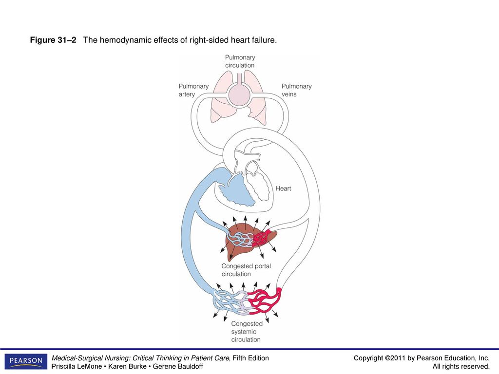 Figure 31–2 The hemodynamic effects of right-sided heart failure.