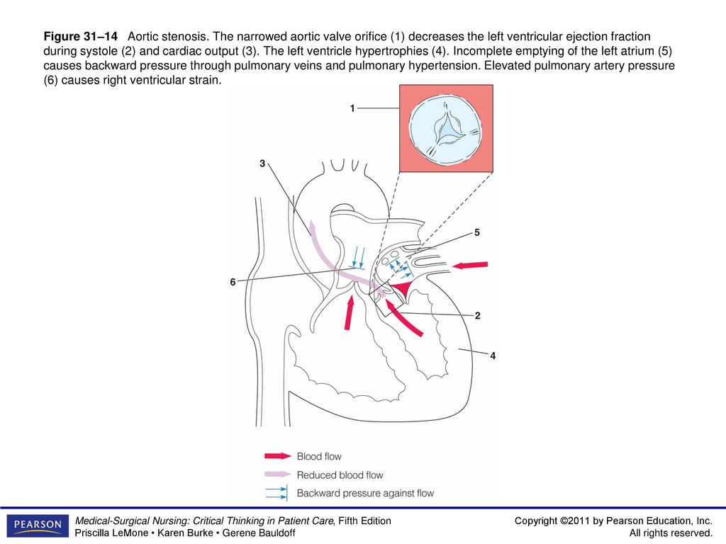 Figure 31–14 Aortic stenosis