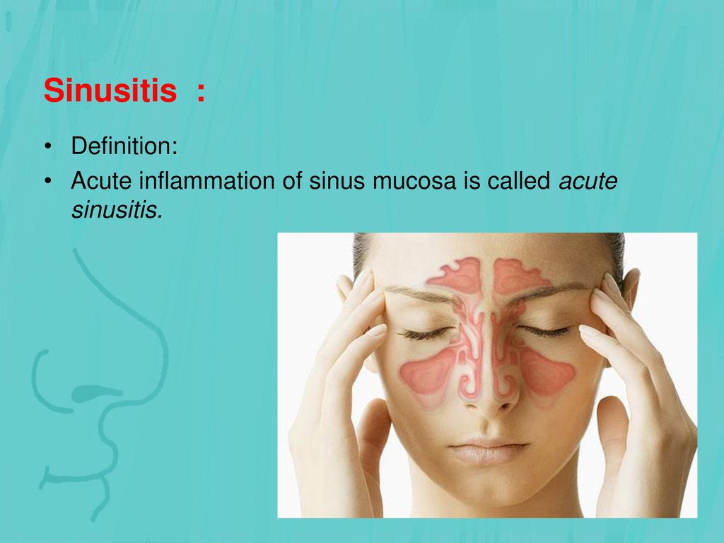 Acute inflammation of sinus mucosa is called acute sinusitis. 