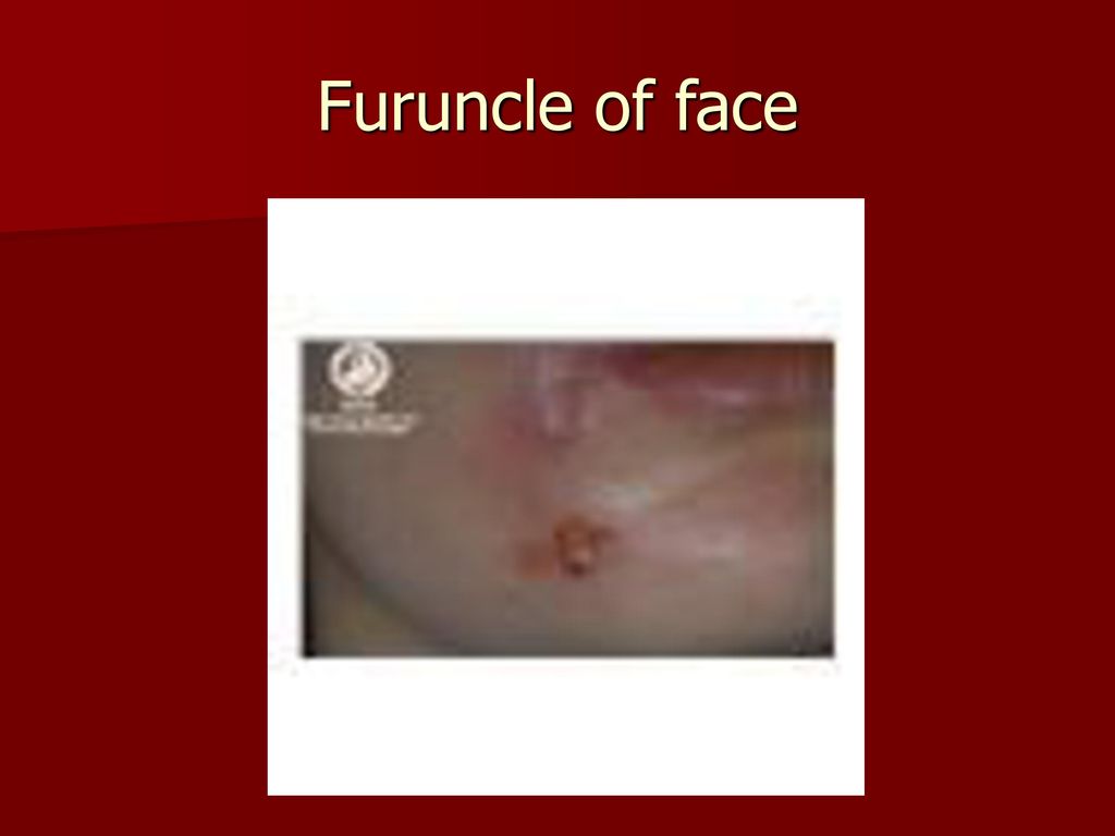 Furuncle of face