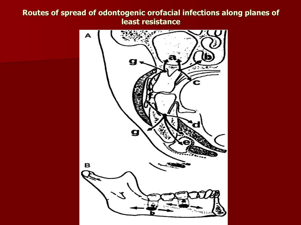 Routes of spread of odontogenic orofacial infections along planes of least resistance