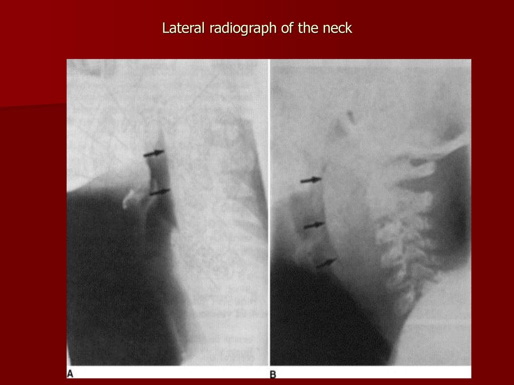 Lateral radiograph of the neck