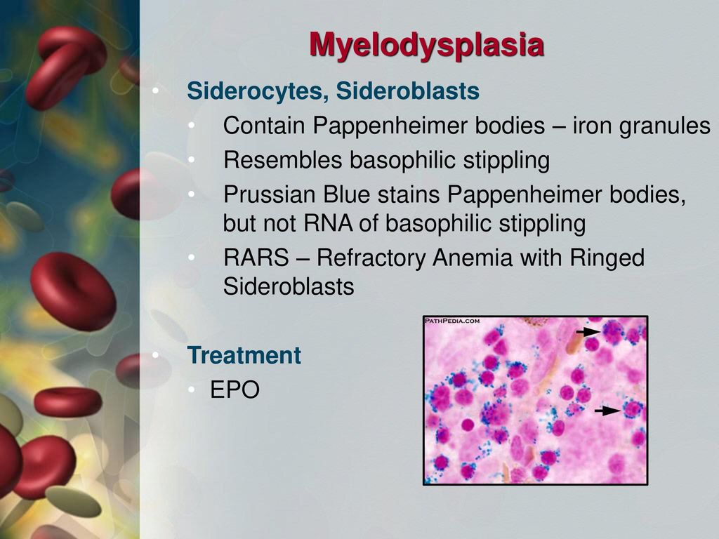 Myelodysplasia Many blast cells in the affected line (5-20%)