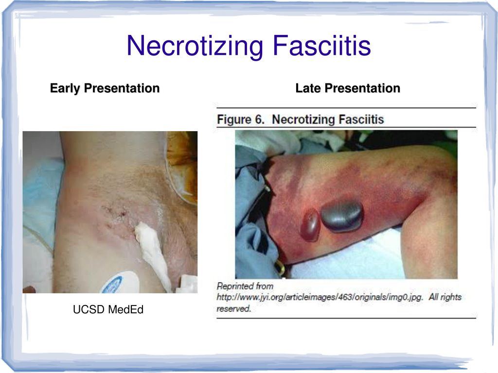 Necrotizing Fasciitis Mini Lecture Ppt Video Online Download Necrotizing Fasciitis Mini Lecture Ppt Video Online Download