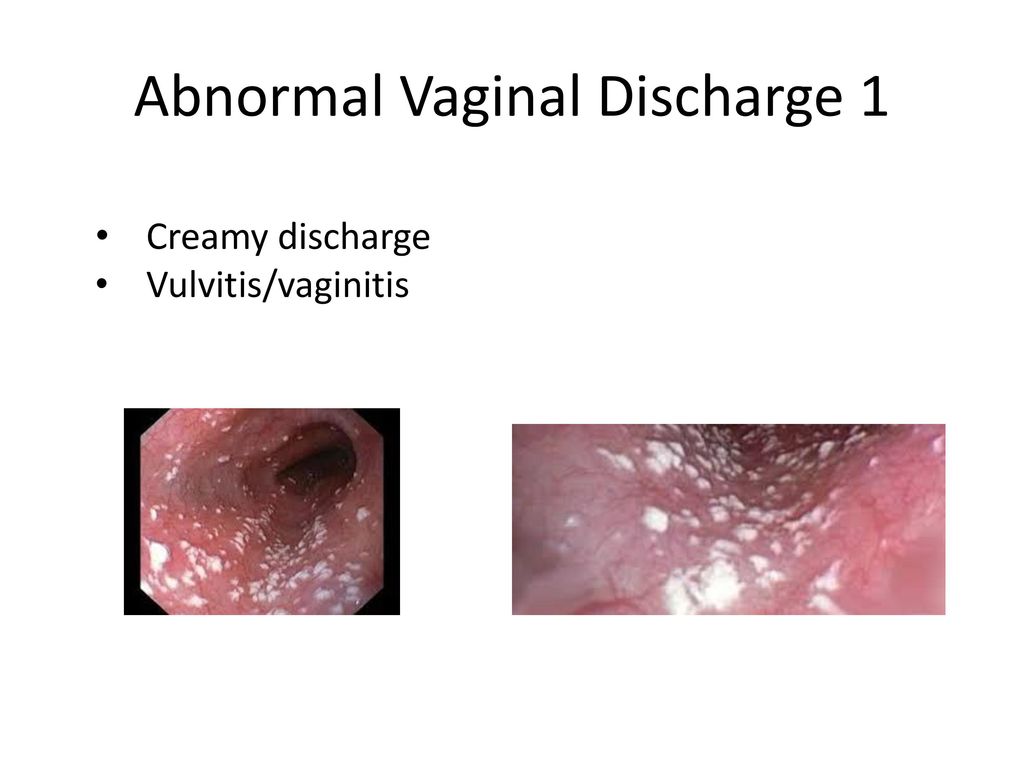 Vaginal Discharge In Pregnancy