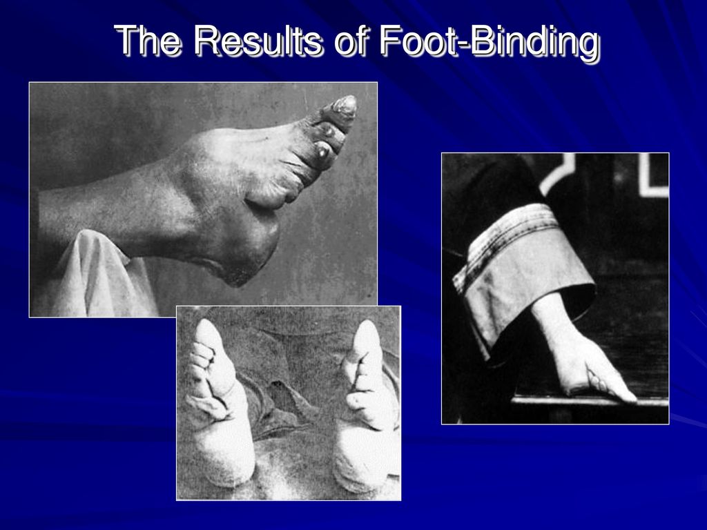 The Results of Foot-Binding