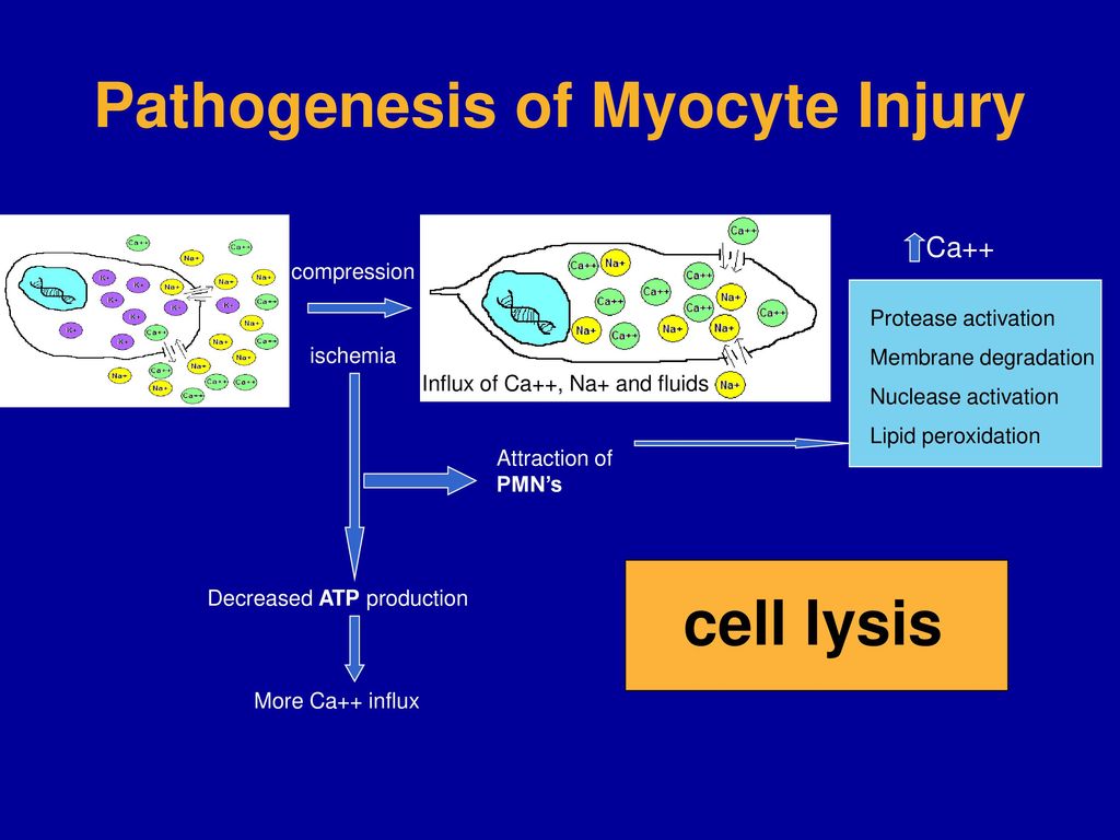 Pathogenesis of Myocyte Injury