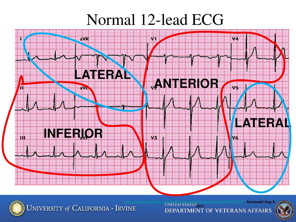 Normal 12-lead ECG LATERAL ANTERIOR LATERAL INFERIOR.
