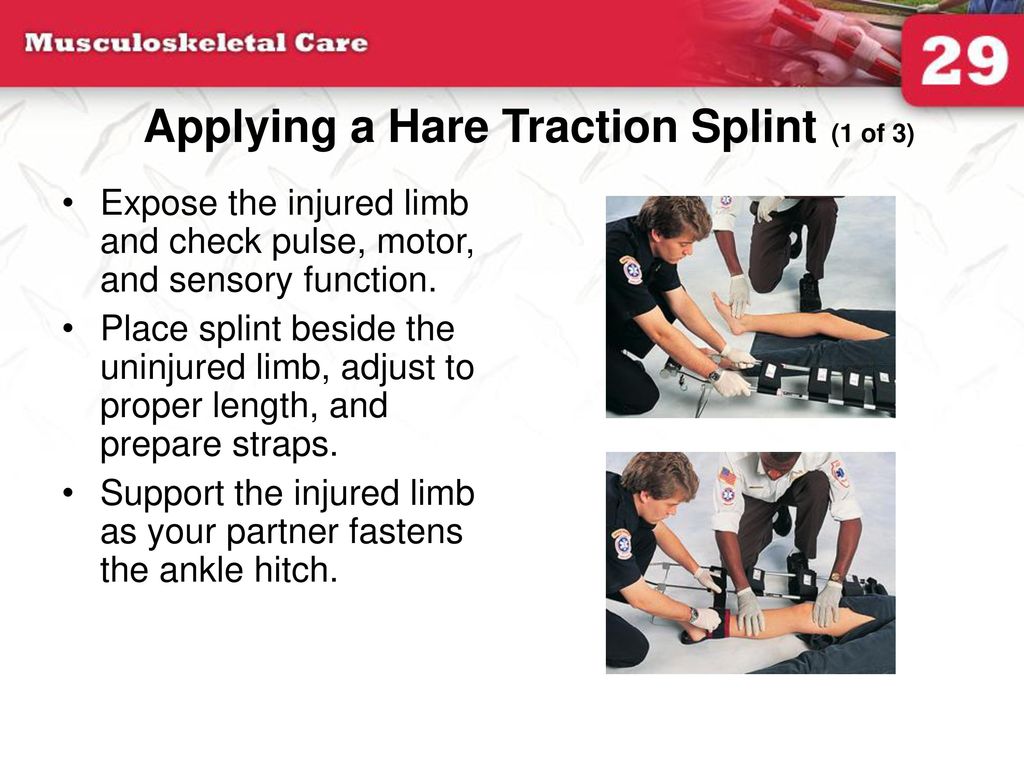 PPT Applying A Hare Traction Splint (3 Of 3) PowerPoint, 53% OFF