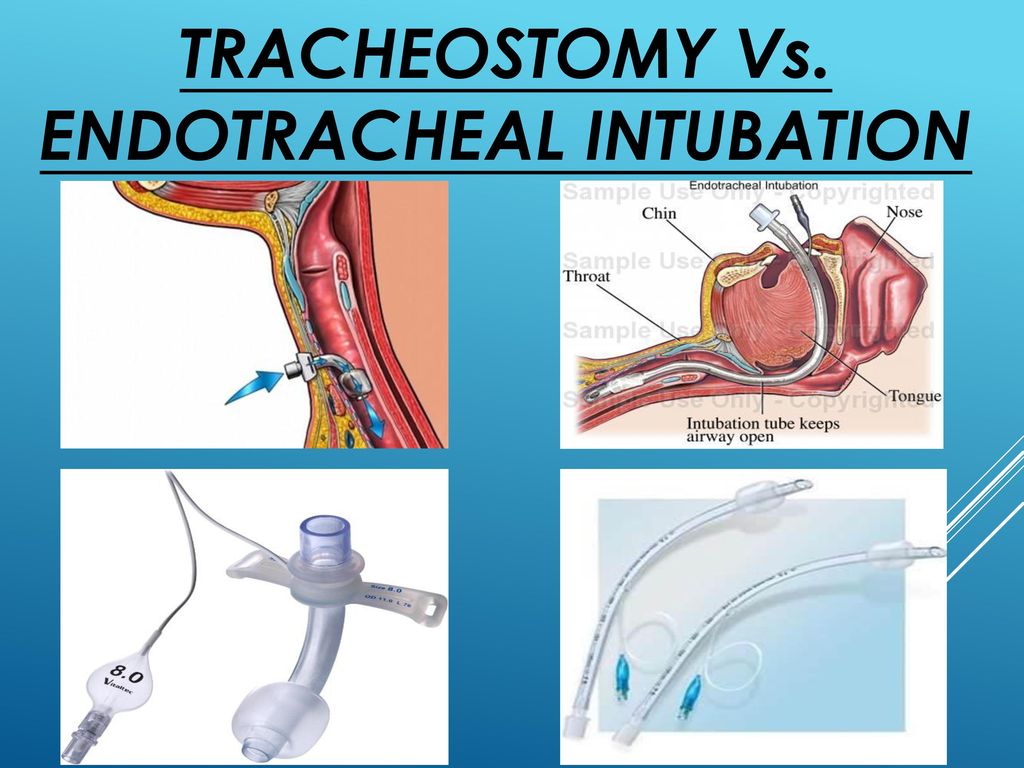 ‘Rota-Trach™’ Double Lumen Tracheostomy Tube - ppt video online download