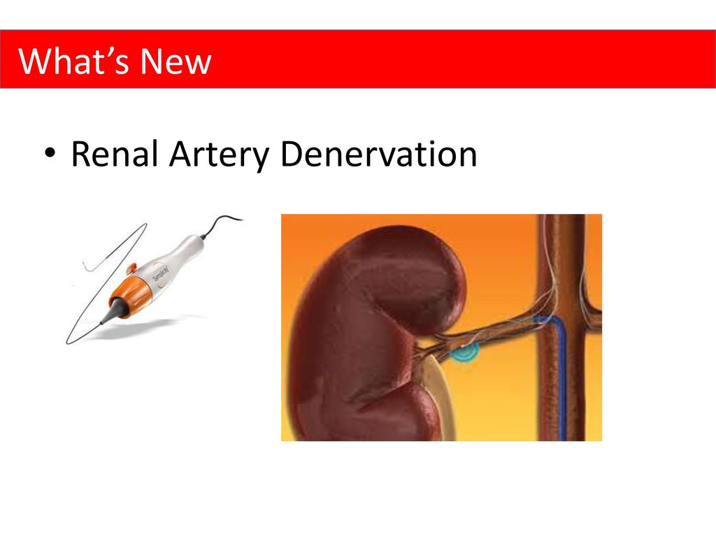 What’s New Renal Artery Denervation