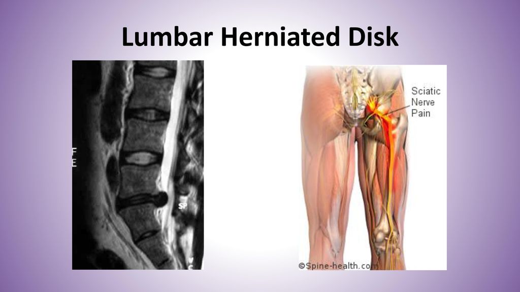 Lumbar Herniated Disk