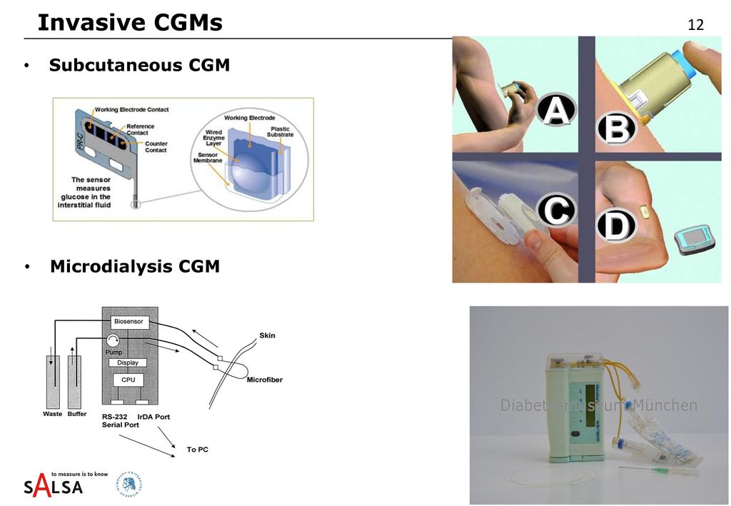 Invasive CGMs 12 Subcutaneous CGM Microdialysis CGM
