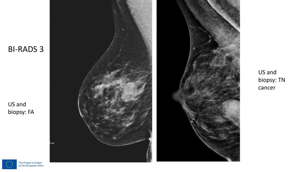 Bi rads 0. Bi-rads 3 молочной железы маммограмма. Rads 3 на маммографии что такое. Маммография классификация bi-rads.