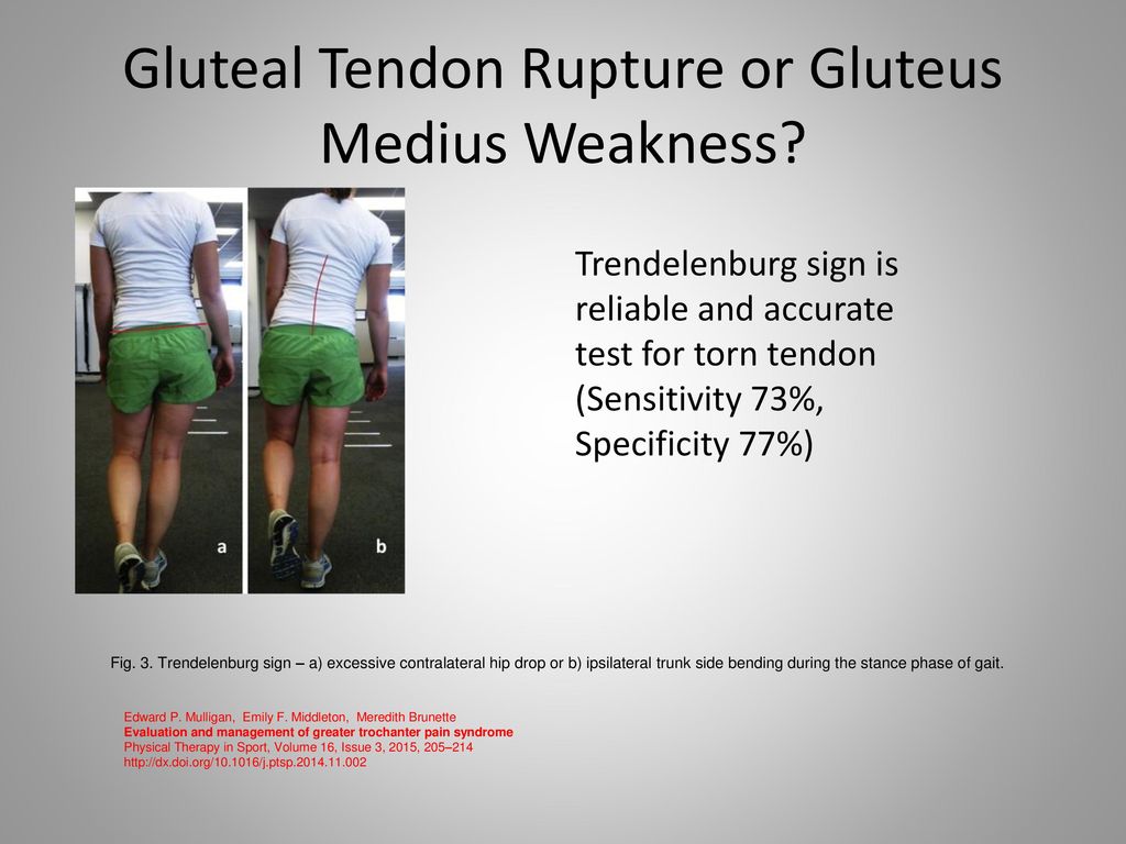 https://slideplayer.com/slide/12320525/73/images/14/Gluteal+Tendon+Rupture+or+Gluteus+Medius+Weakness.jpg