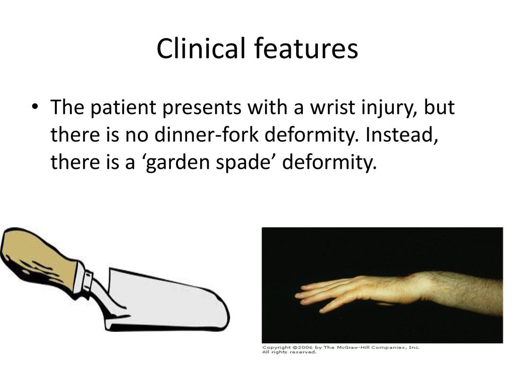 Fractures Of The Distal Radius In Adults Ppt Download