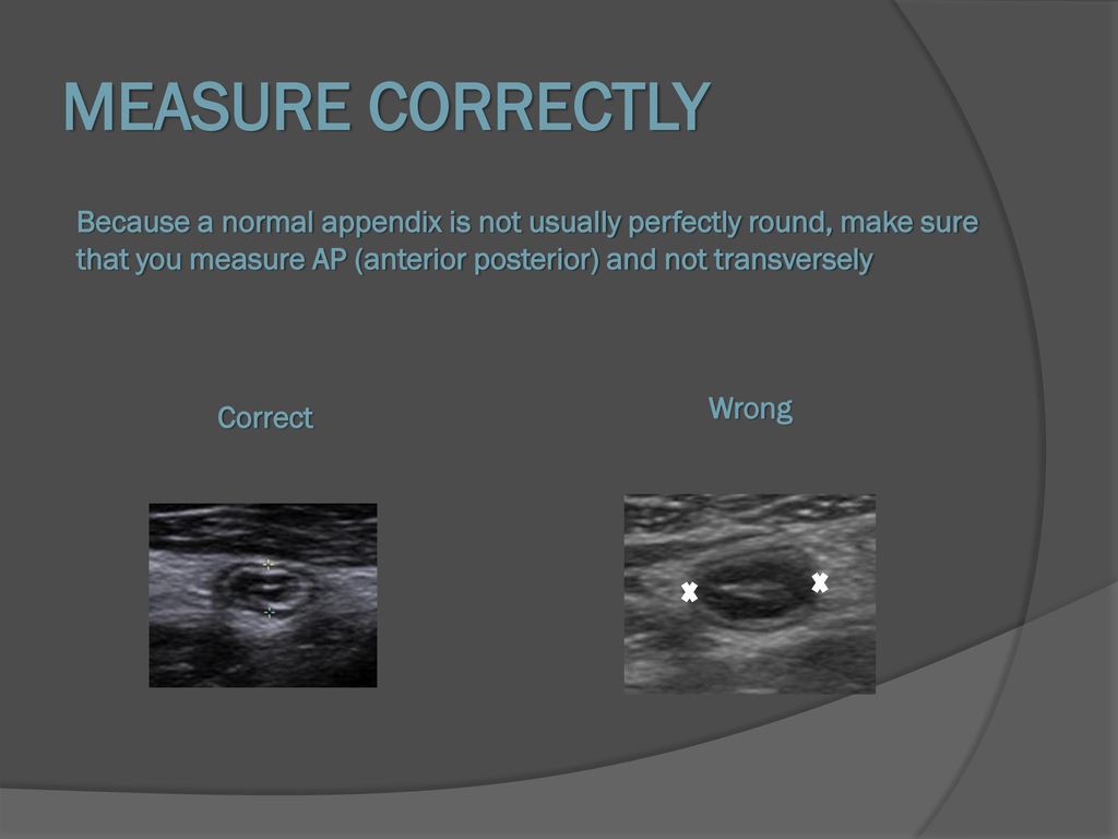 MEASURE CORRECTLY Because a normal appendix is not usually perfectly round, make sure that you measure AP (anterior posterior) and not transversely.