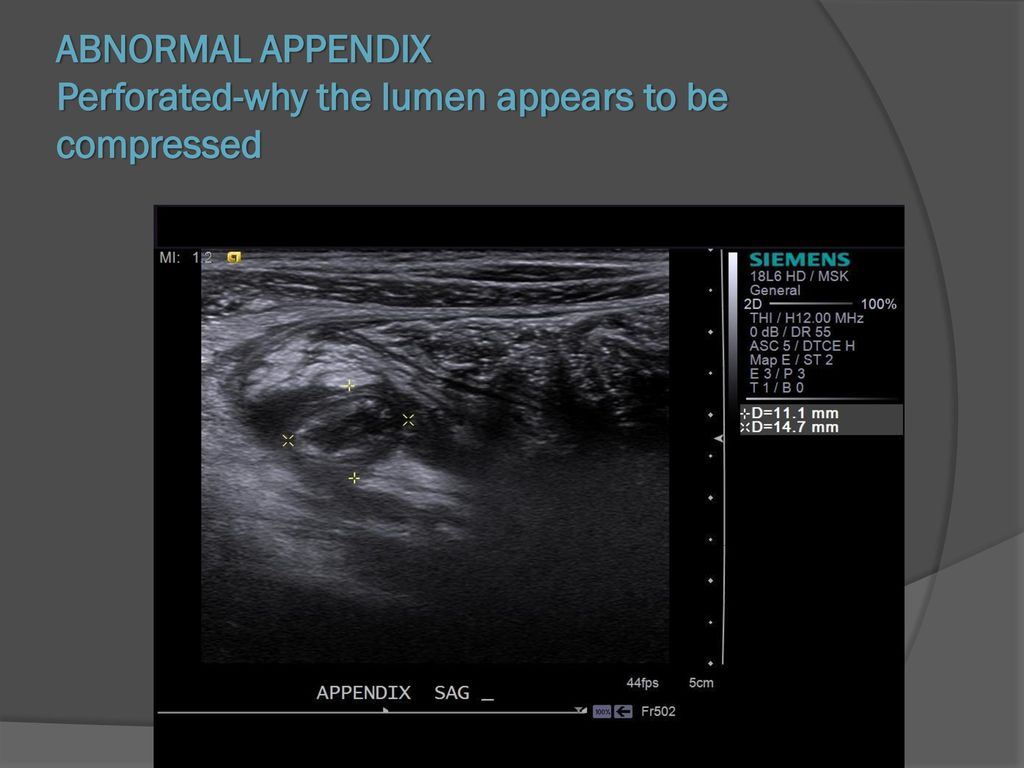 ABNORMAL APPENDIX Perforated-why the lumen appears to be compressed