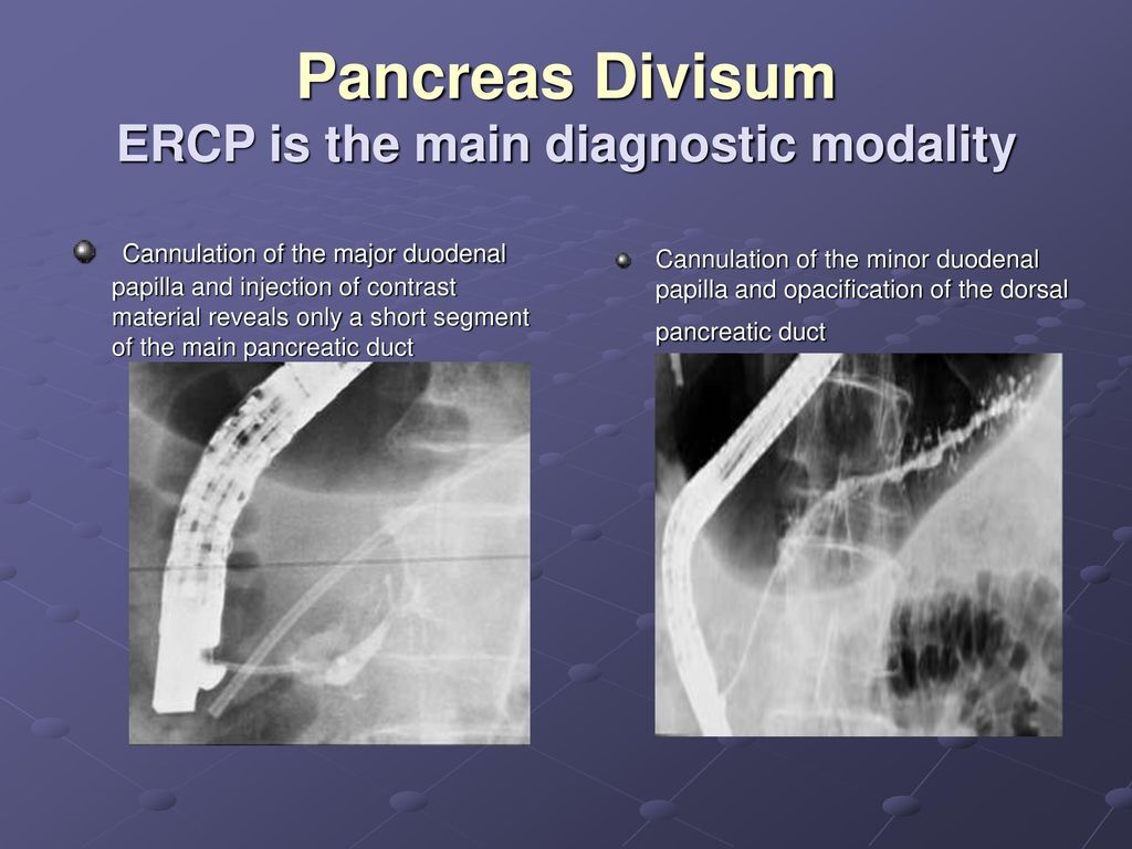 Pancreas Divisum ERCP is the main diagnostic modality