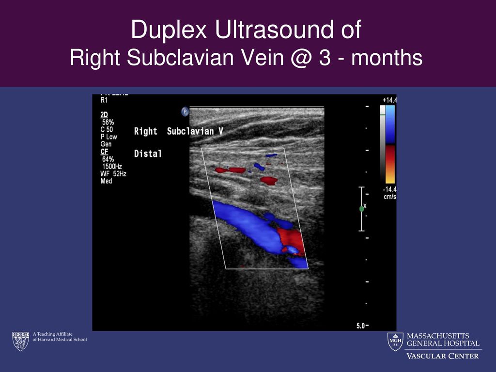 Duplex Ultrasound of Right Subclavian 3 - months