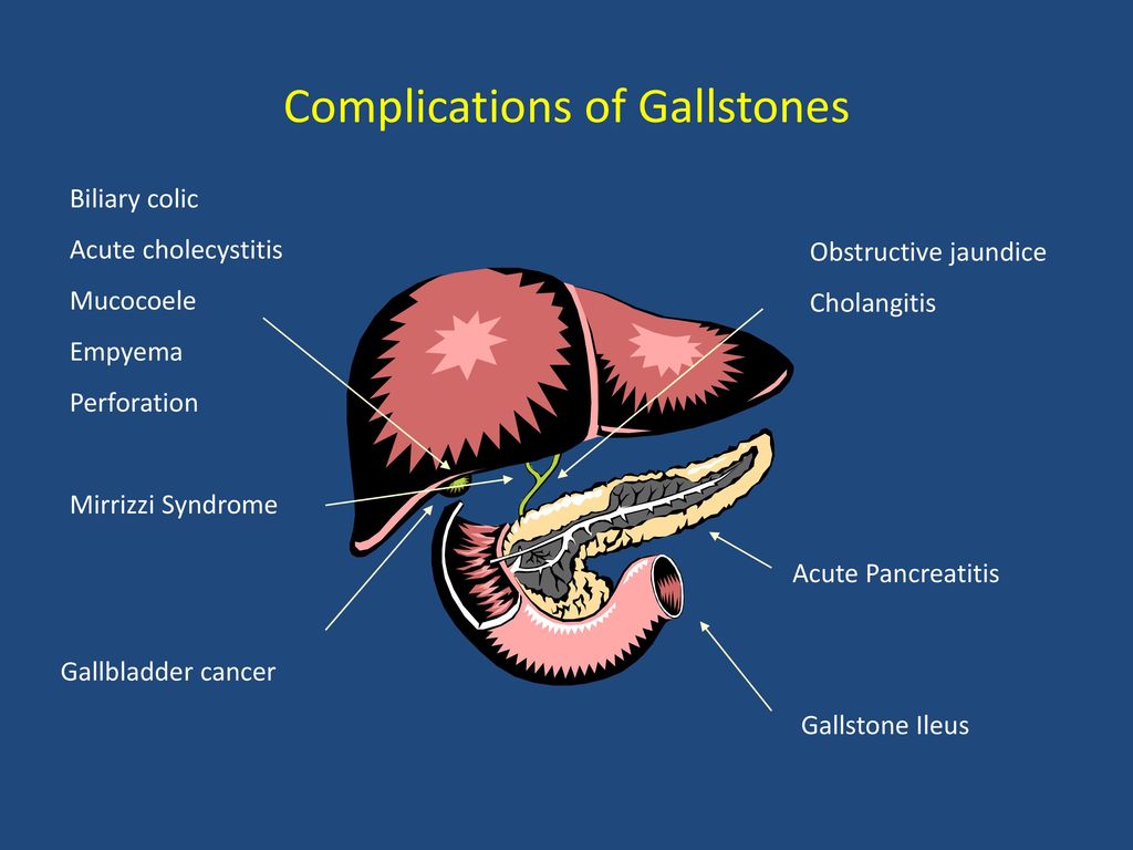 Complications of Gallstones