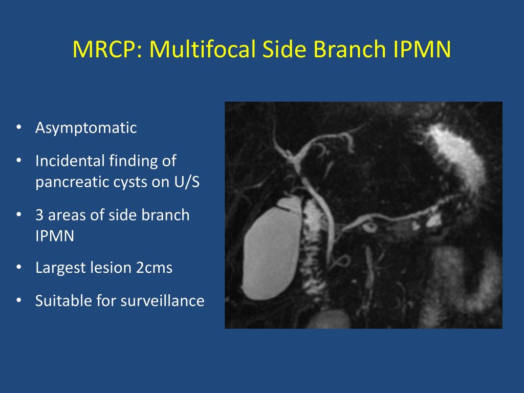 MRCP: Multifocal Side Branch IPMN