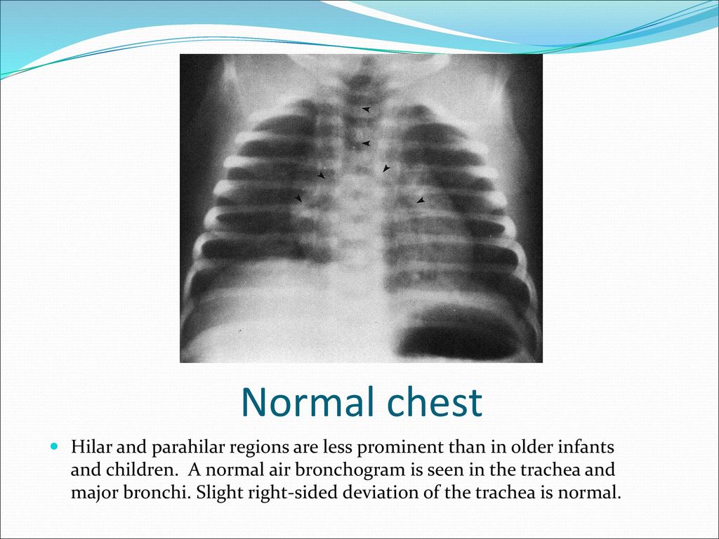 Common Neonatal Chest Xrays Ppt Download
