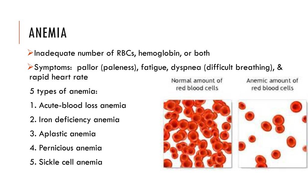 3. Aplastic anemia. 