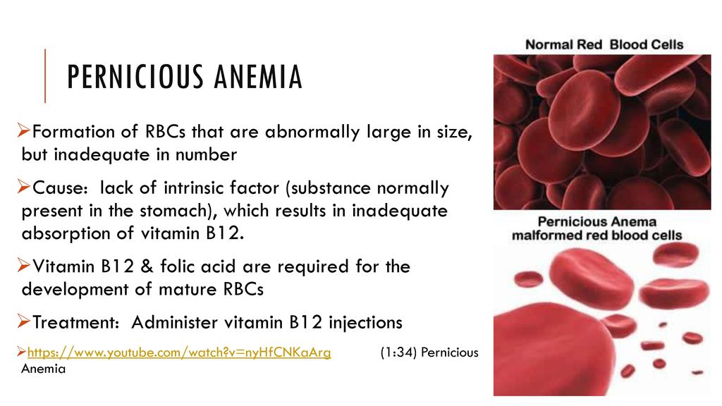 Pernicious anemia Formation of RBCs that are abnormally large in size, but ...