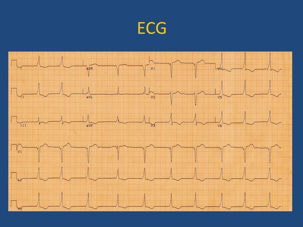 Arrhythmia in babies and children - ppt download