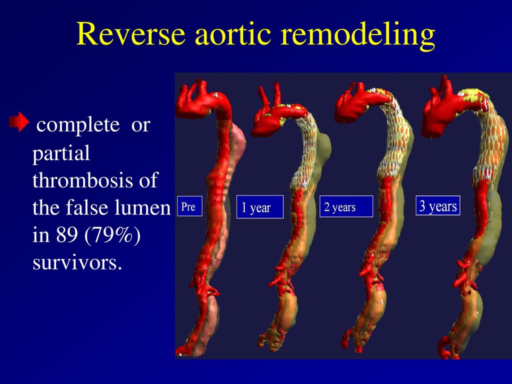 Reverse aortic remodeling