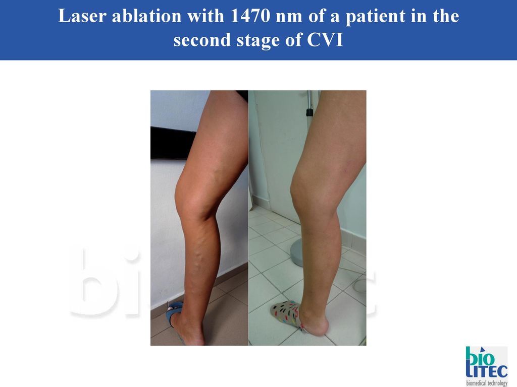 Laser ablation with 1470 nm of a patient in the second stage of CVI