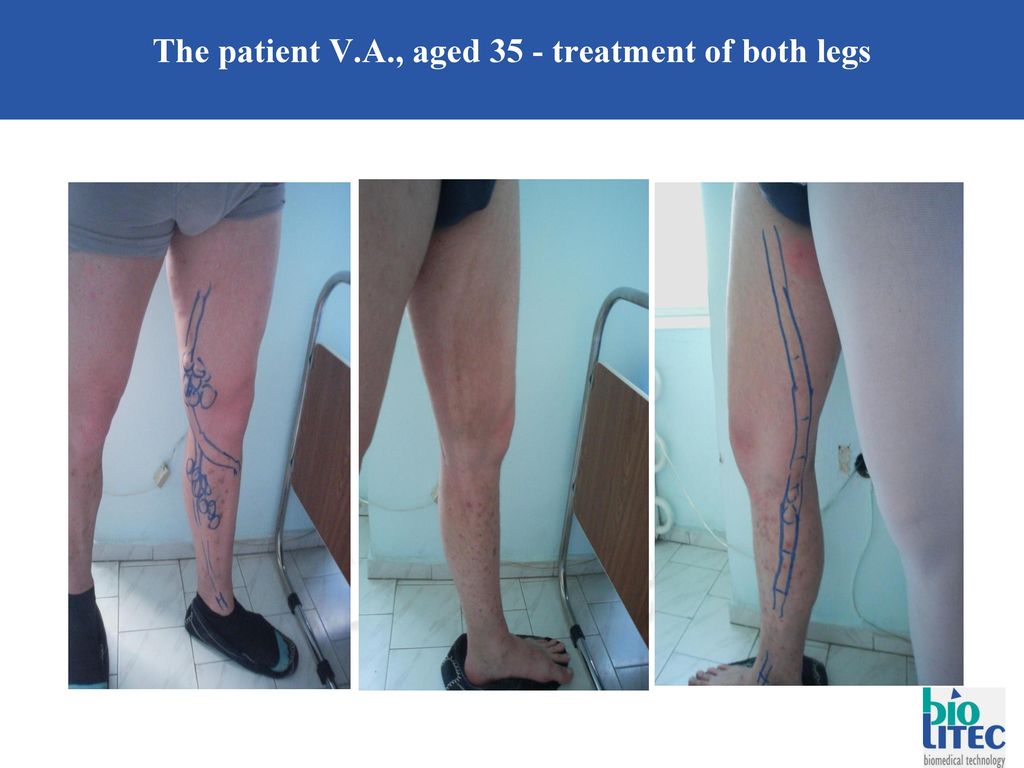 The patient V.А., aged 35 - treatment of both legs