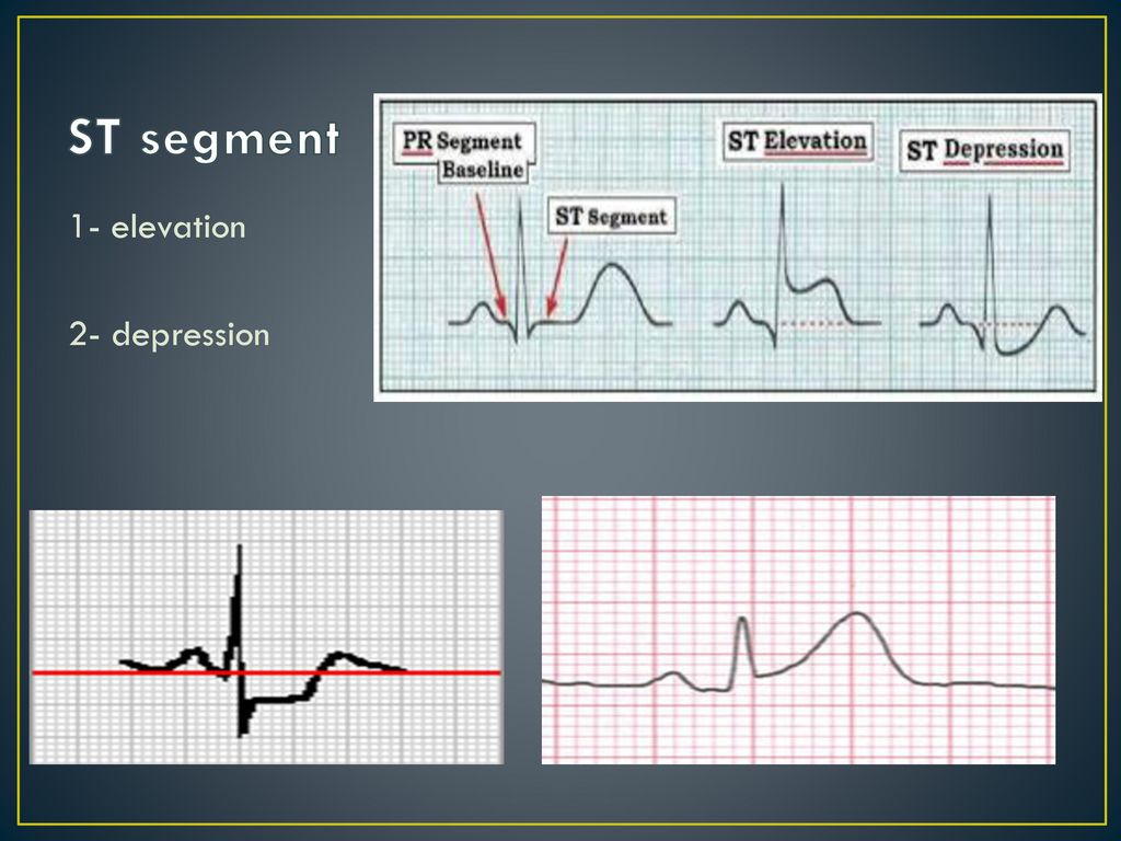 Electro Cardio Graphy (ECG) - ppt download