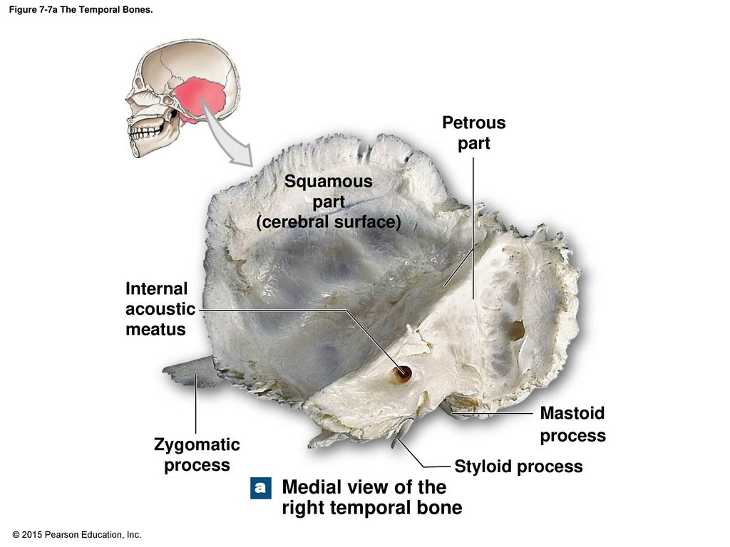 Где находится височная кость. Petrous Part of temporal. Petrous Bone. The Part of temporal Bone in ?.