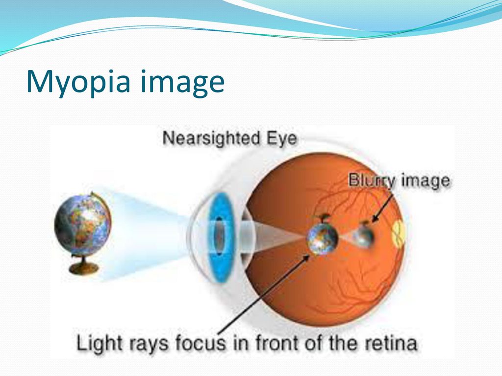 myopia probléma
