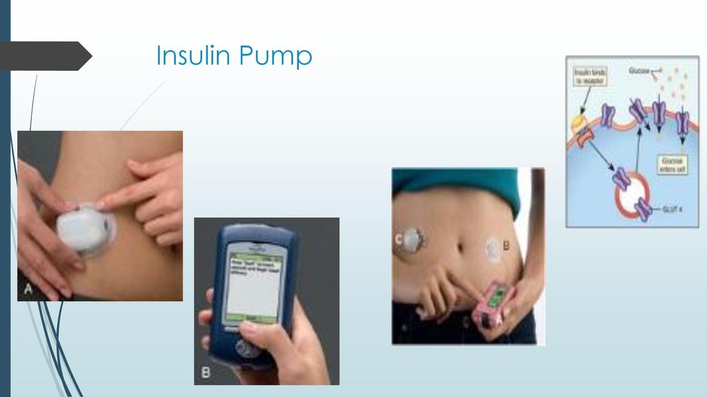 Insulin Pump Insulin Pump Continuous subcutaneous infusion
