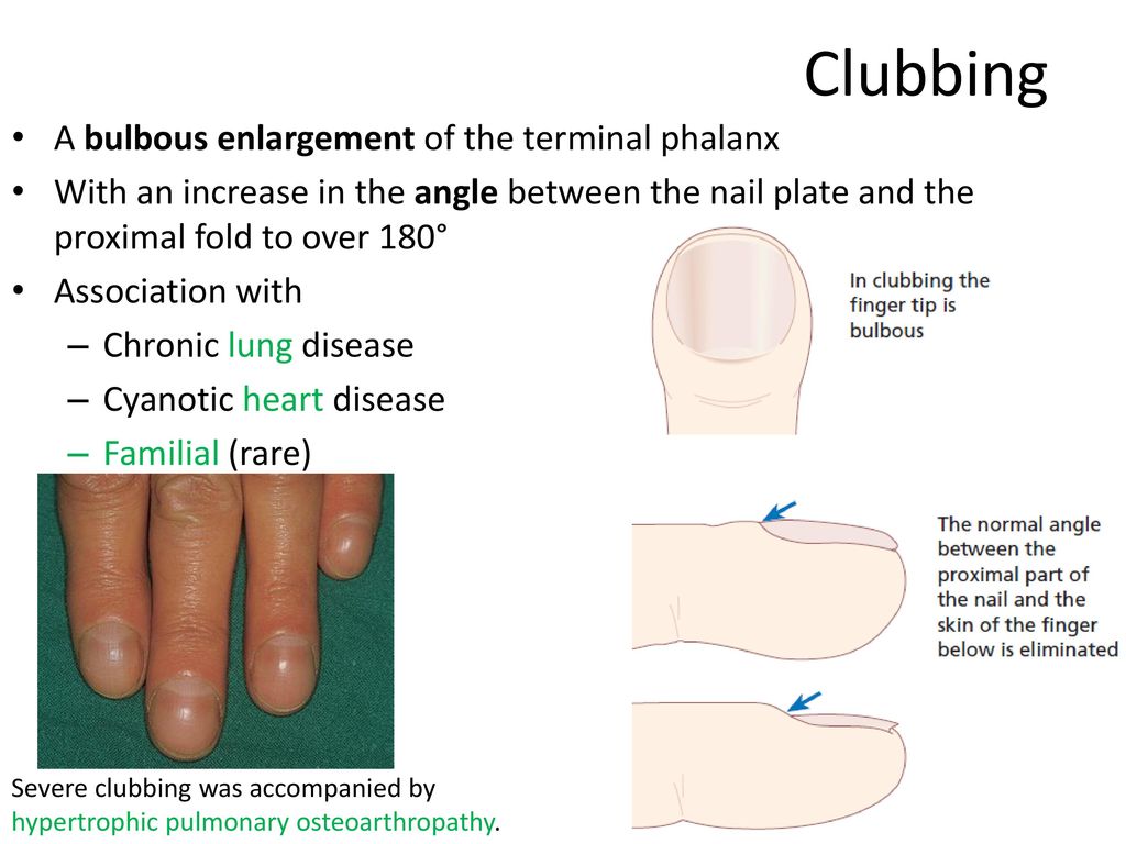 Clubbing of the Fingers or Toes