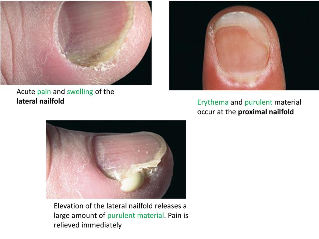 Nail is Systemic Disorders: Main Signs and Clues