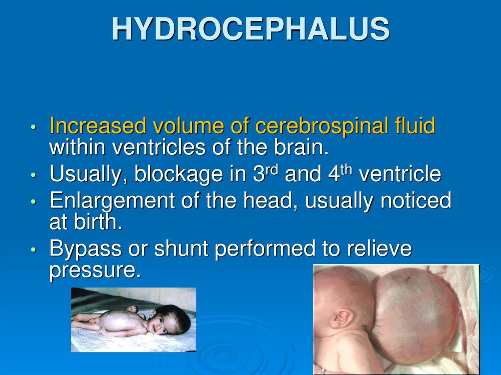 HYDROCEPHALUS Increased volume of cerebrospinal fluid within ventricles of the brain. Usually, blockage in 3rd and 4th ventricle.