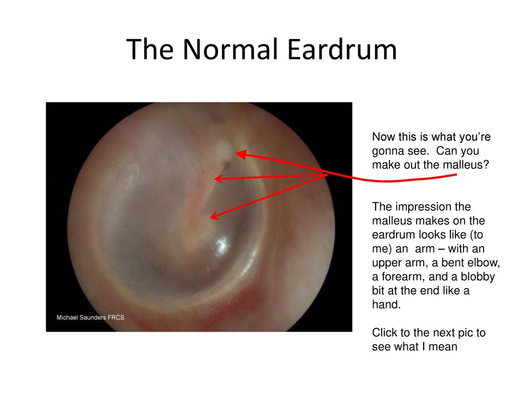 The Eardrum Made Simple - ppt download