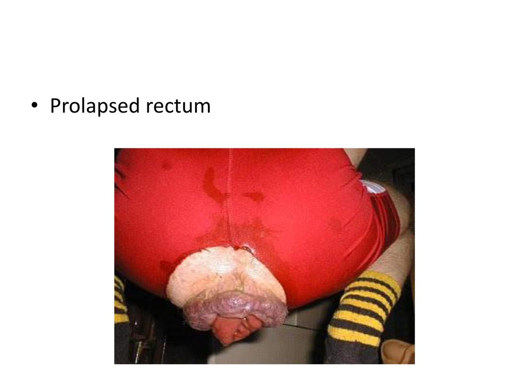 Weightlifter Rectal Prolapse